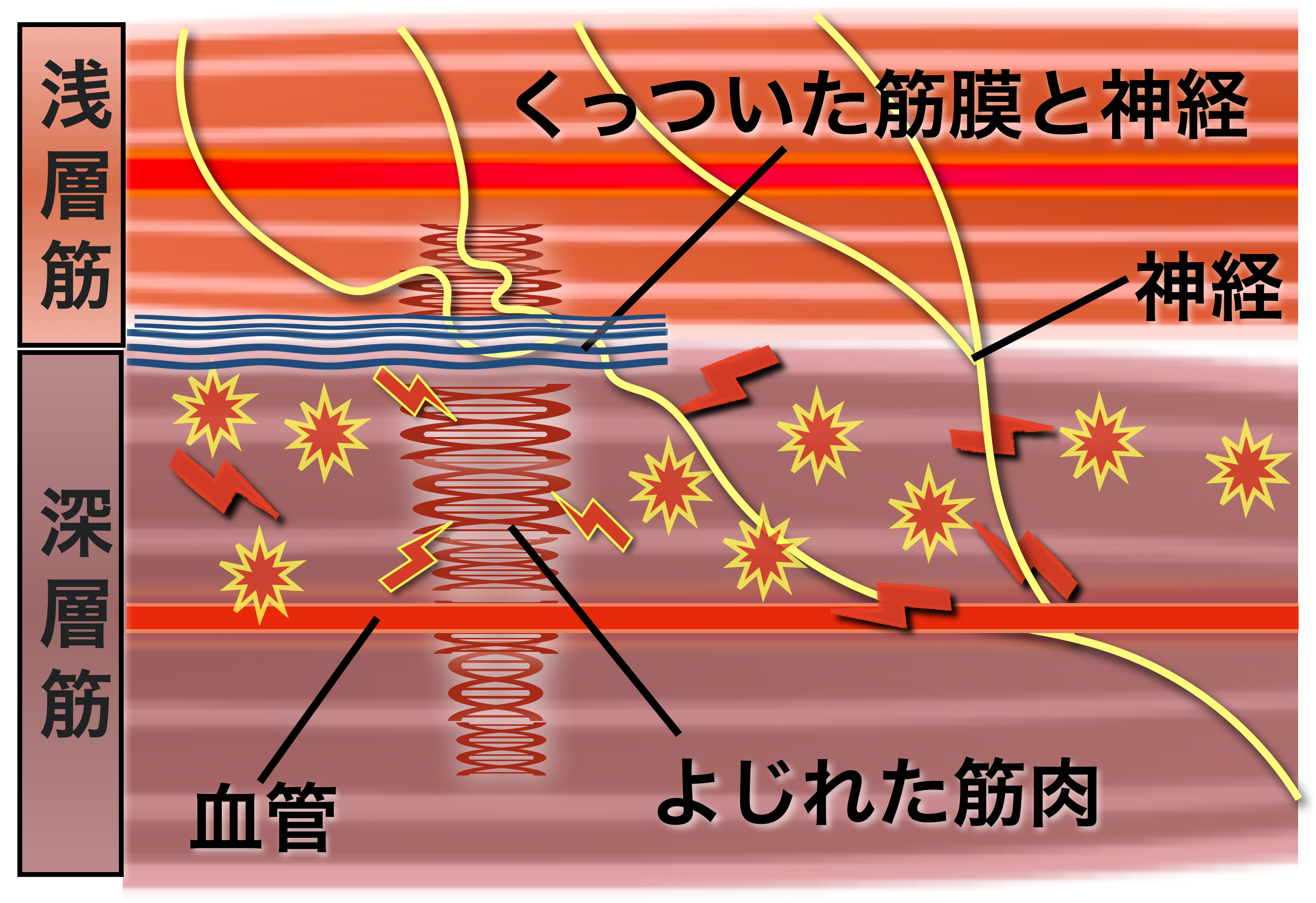 慢性的こりから癒着した筋膜.png