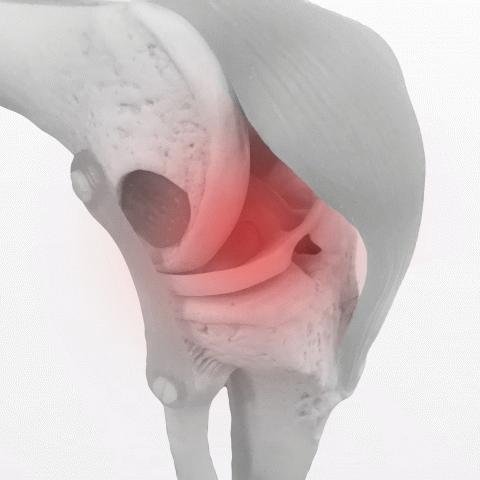 【変形性膝関節症】膝の内側が痛くなた方へ。