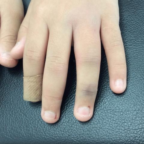 小学校5年女子 ブランコから落ちてつき指をして骨折し、名古屋市緑区幹整体院