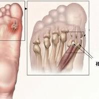 足の親指のつけ根の痛み。「種子骨障害（種子骨炎）」に対する処置。
