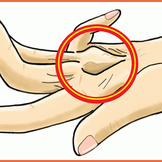 手の痛み・シビレ・指の痛み(デュピュイトラン拘縮)