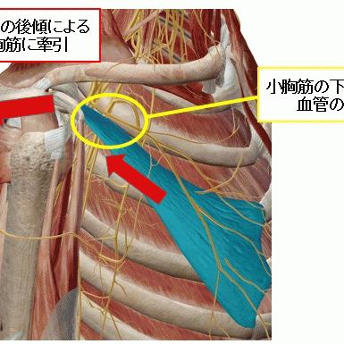 【胸郭出口症候群】か？30代男性 両腕のだるさとしびれ改善例