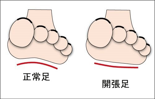 扁平足の横アーチ
