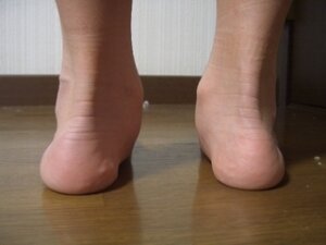 外反扁平足