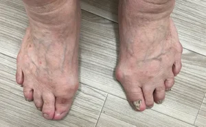 足のむくみ足底筋膜炎