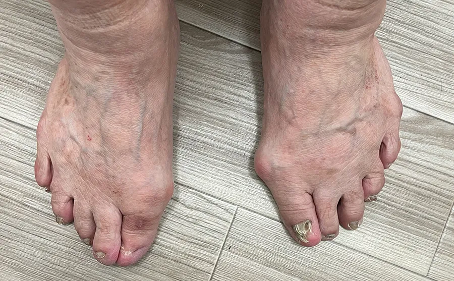 足のむくみ足底筋膜炎