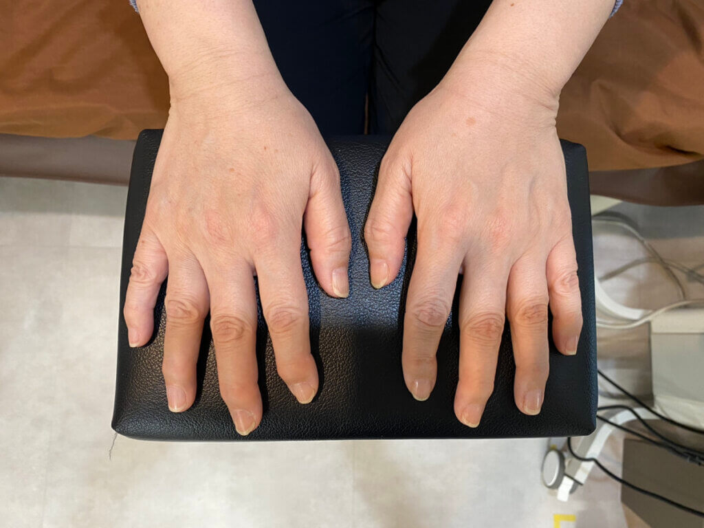 へバーテン結節事例