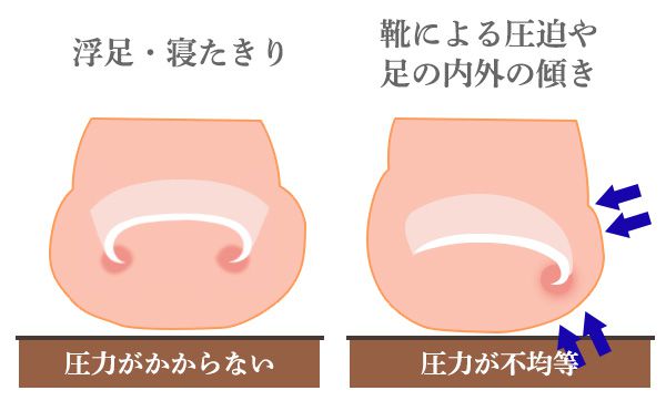 浮足、寝たきりは圧力がかからない、
靴による圧迫は爪にかかる圧力が不均衡