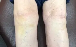 ひざO脚