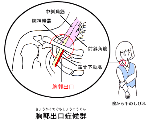 胸郭出口症候群