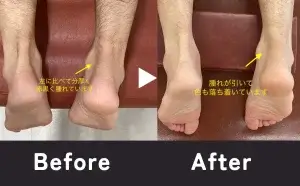 マラソン後のアキレス腱