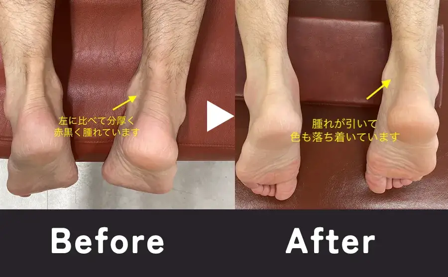 マラソン後のアキレス腱