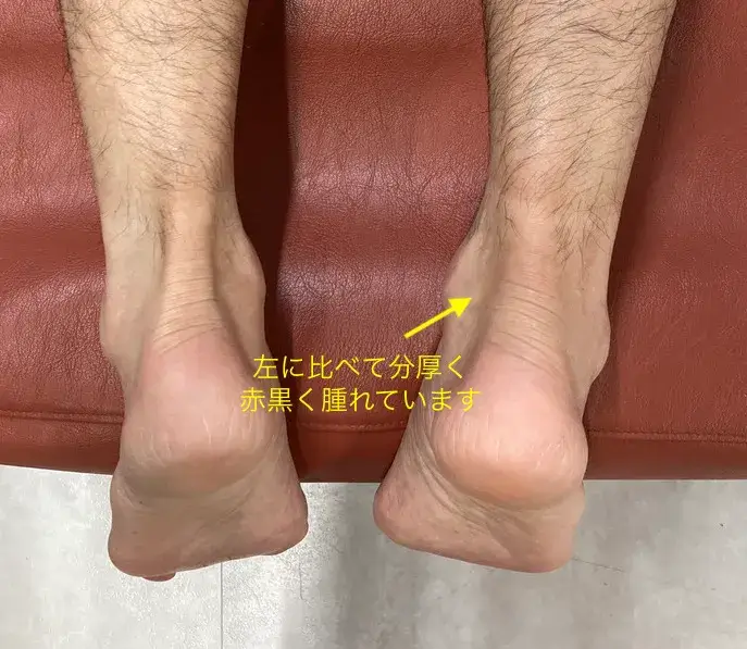 アキレス前