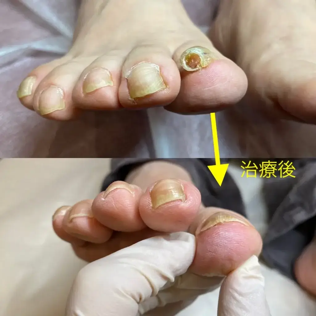 巻き爪事例　幹整体院