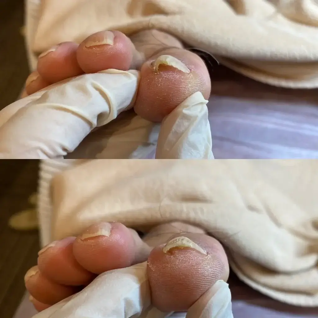 巻き爪事例２　幹整体院