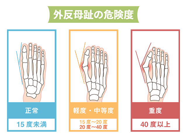 外反母趾の角度別危険度