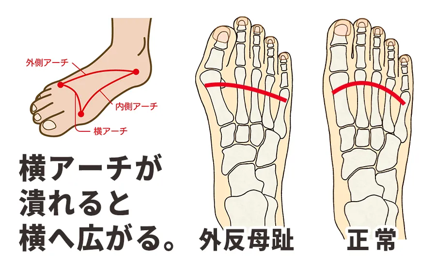 足の横アーチがつぶれると横へ広がる→外反母趾へ
